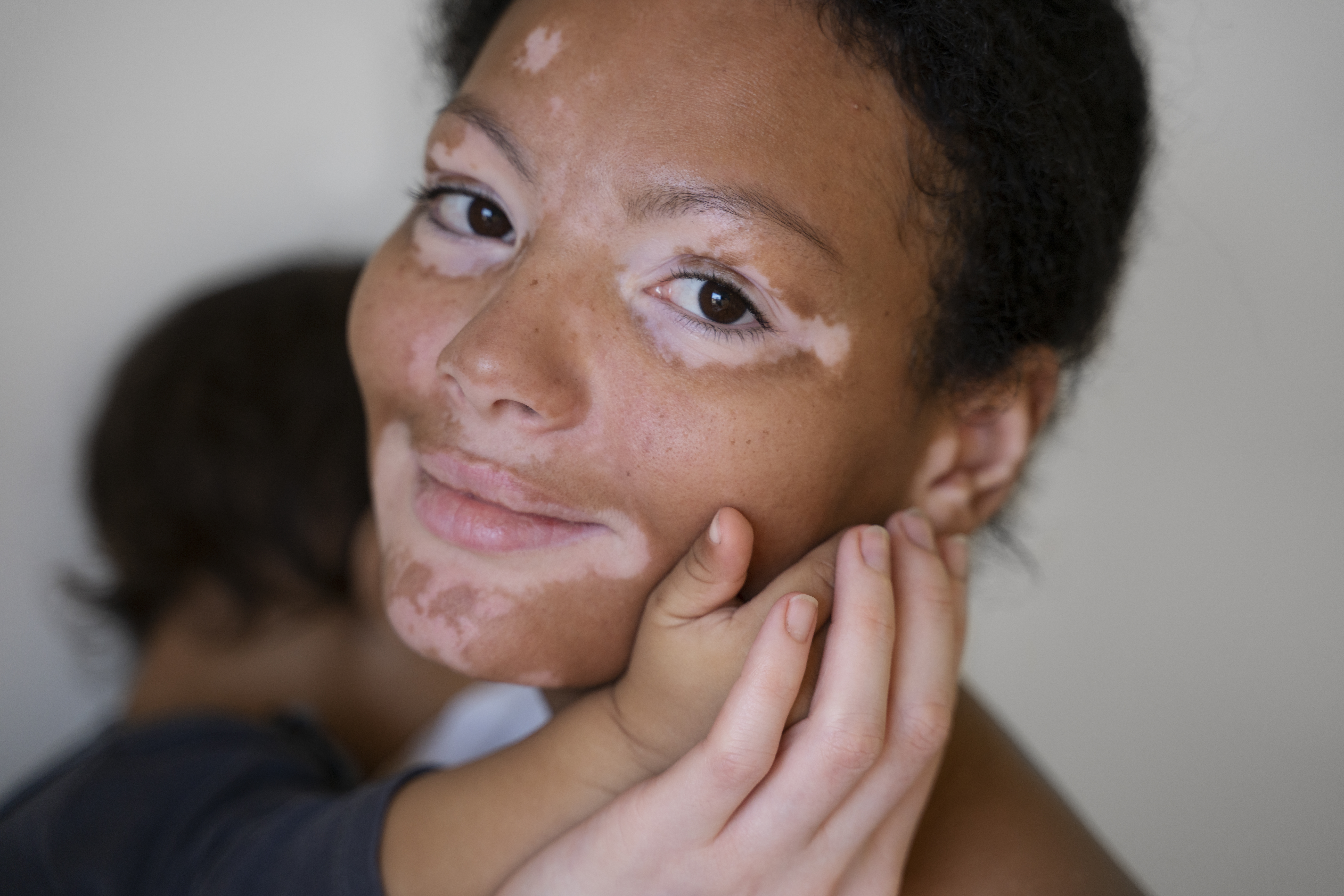 Understanding Vitiligo: